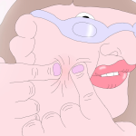 PIMPLE1.jpeg
